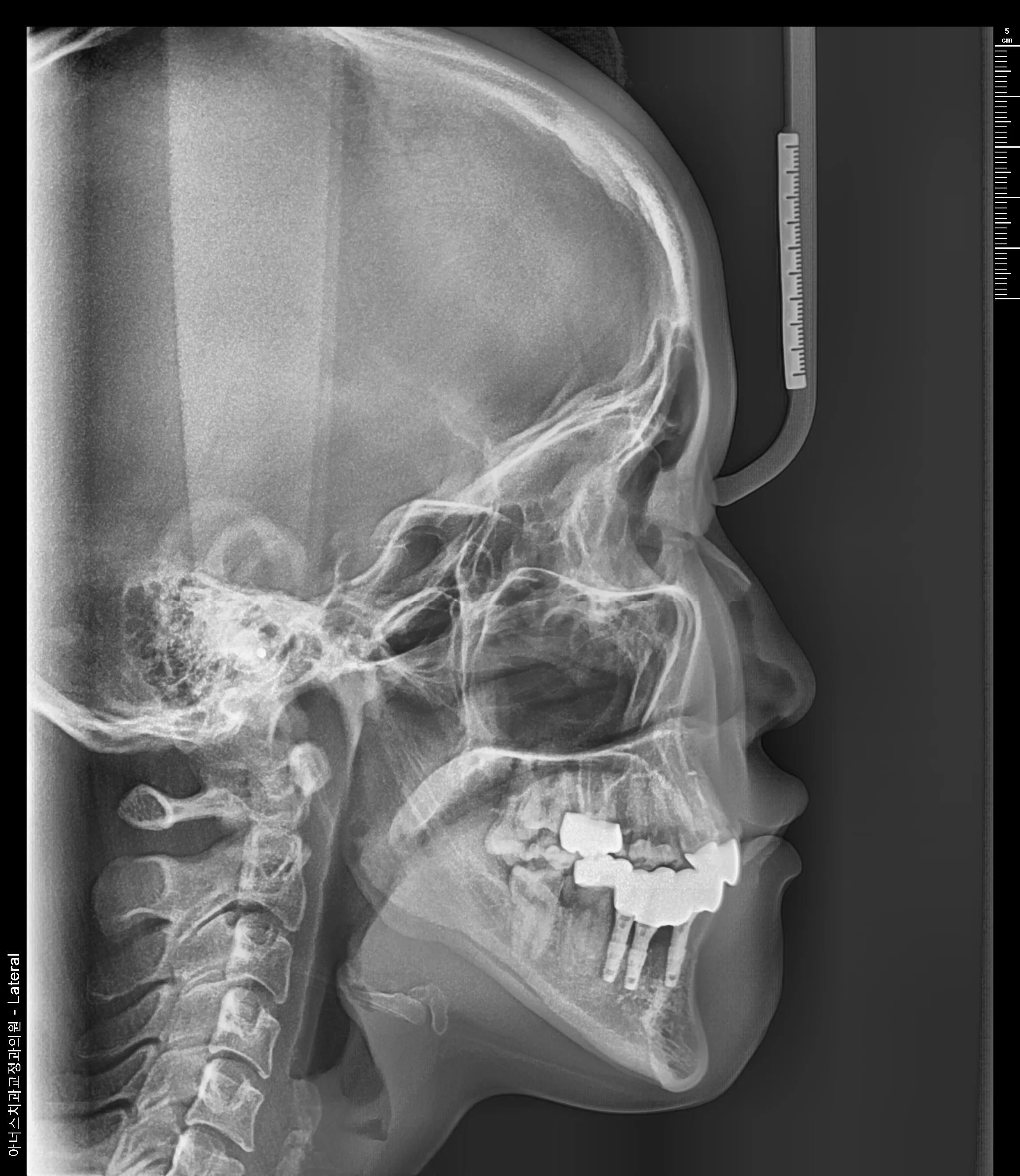 Lateral Ceph