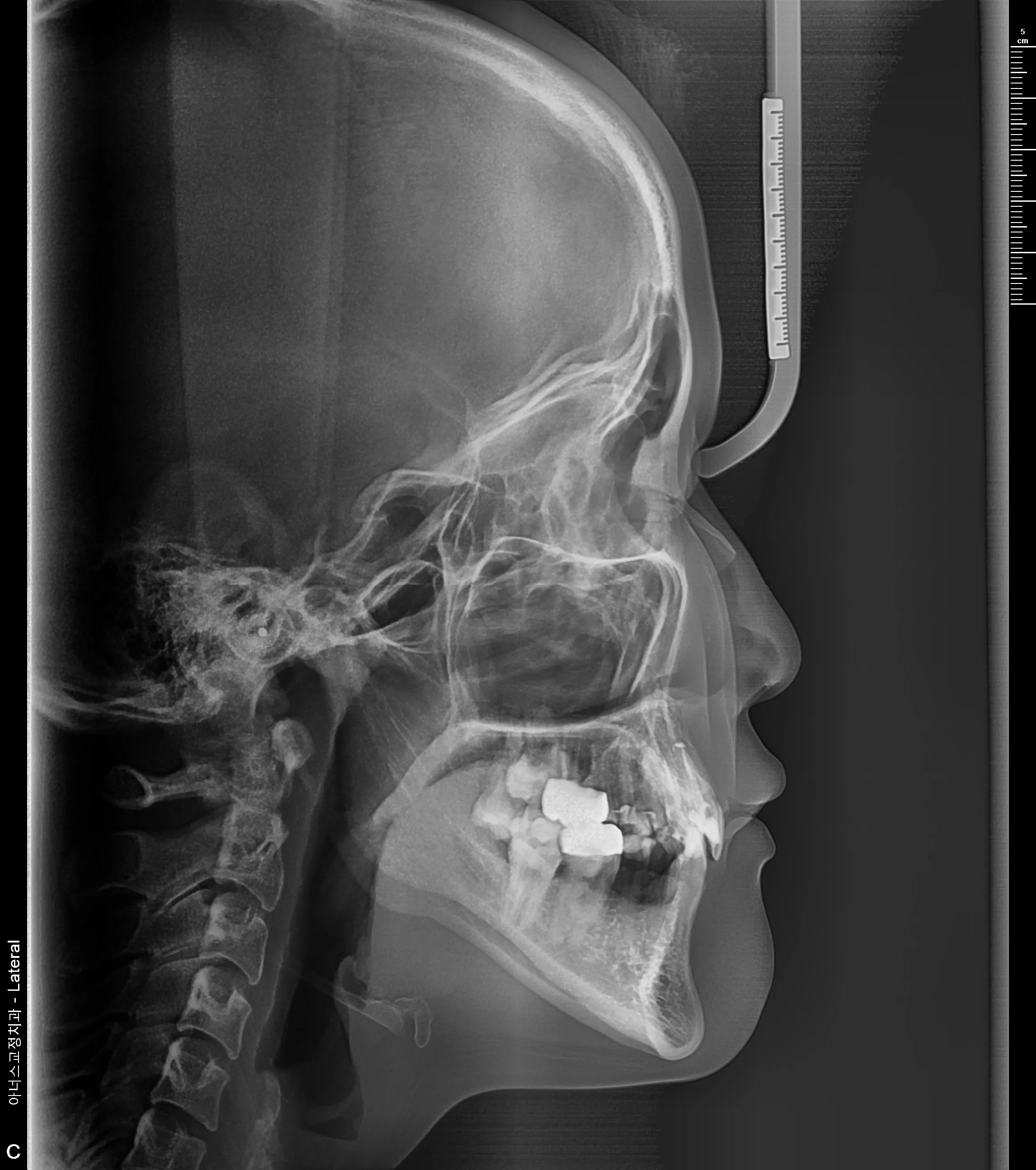 Lateral Ceph
