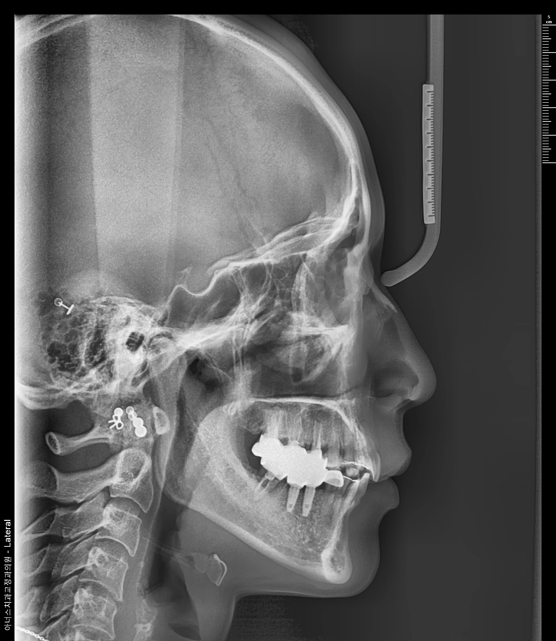 Lateral Ceph