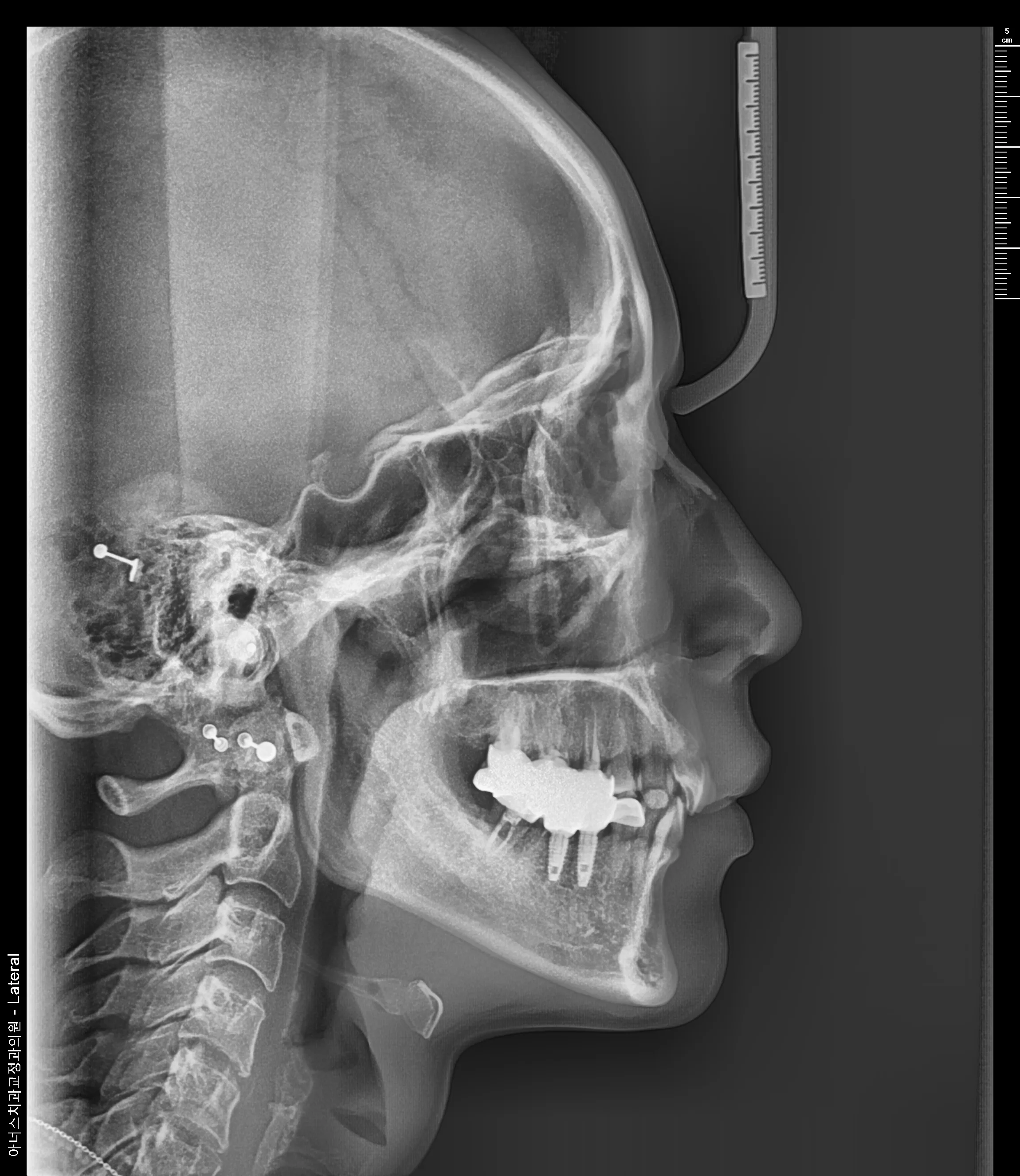 Lateral Ceph