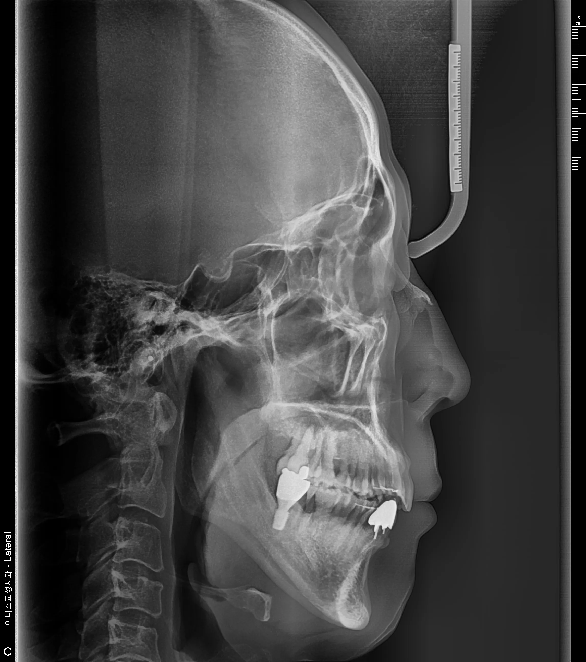 Lateral Ceph