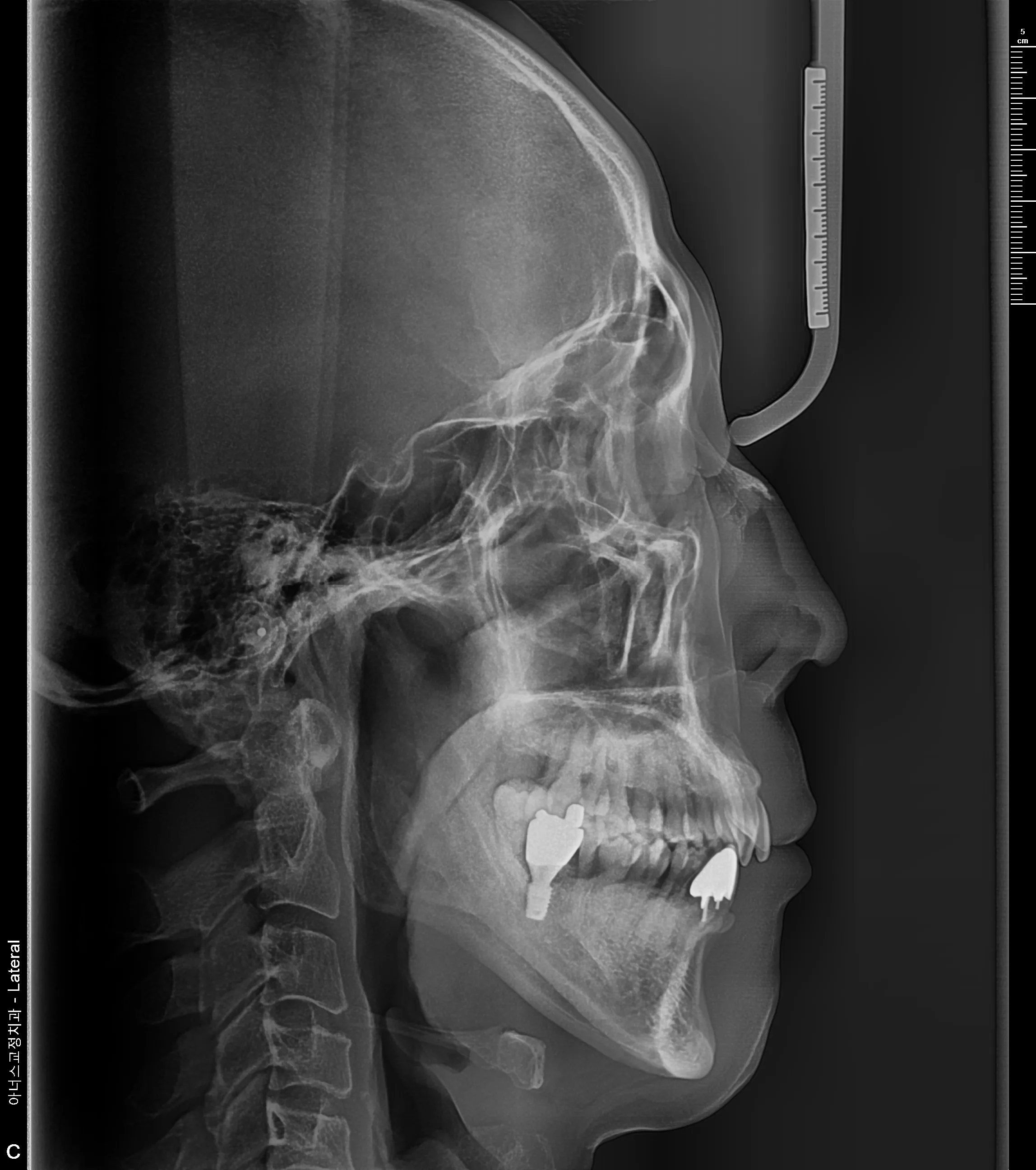 Lateral Ceph