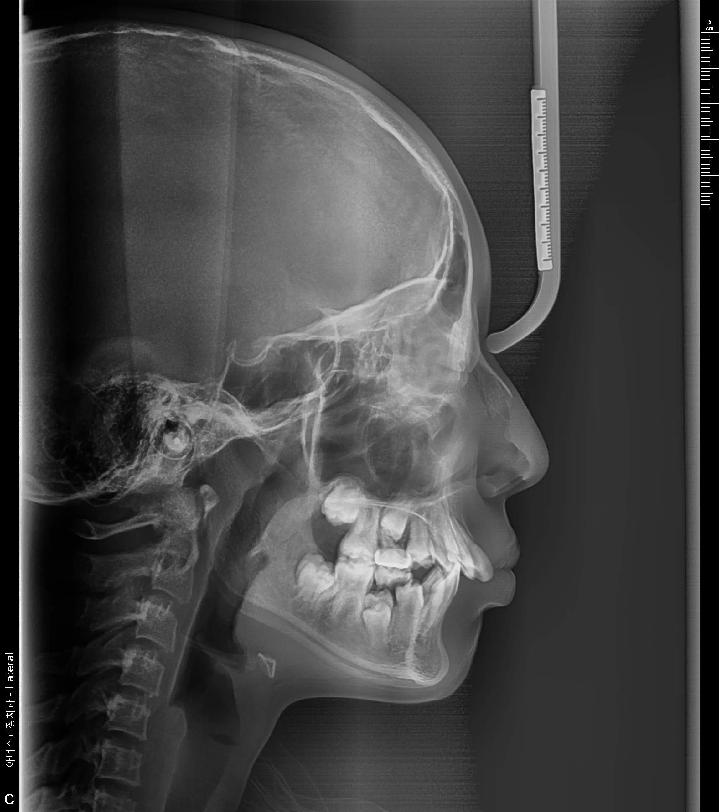 Lateral Ceph