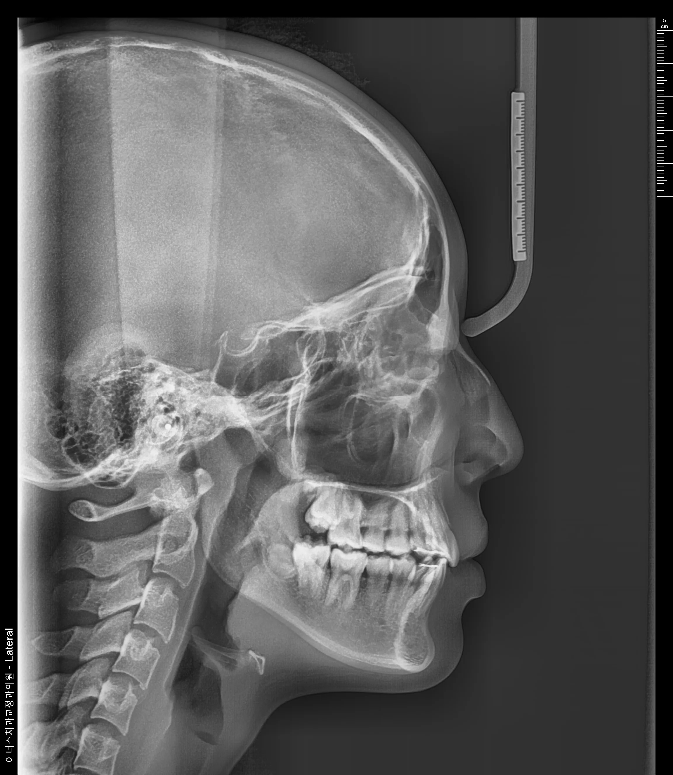 Lateral Ceph