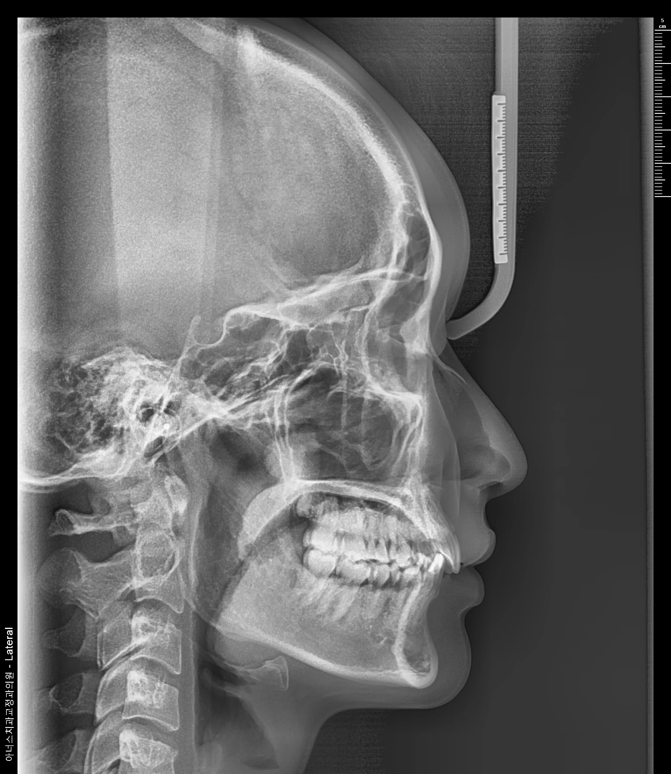 Lateral Ceph