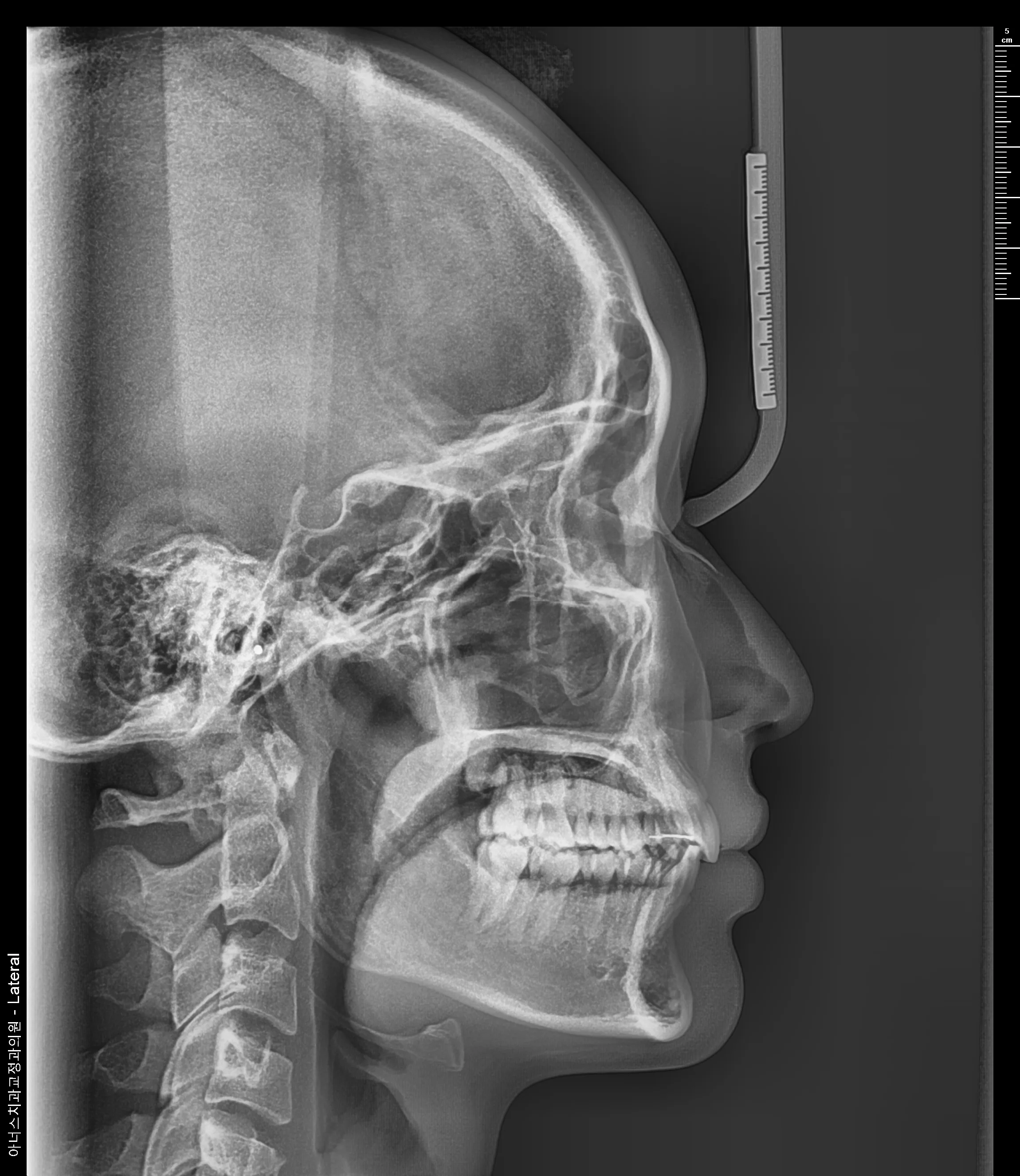 Lateral Ceph