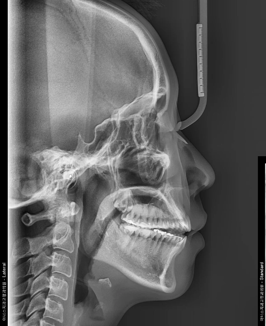 Lateral Ceph