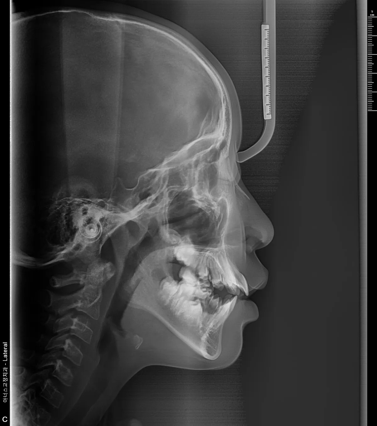 Lateral Ceph