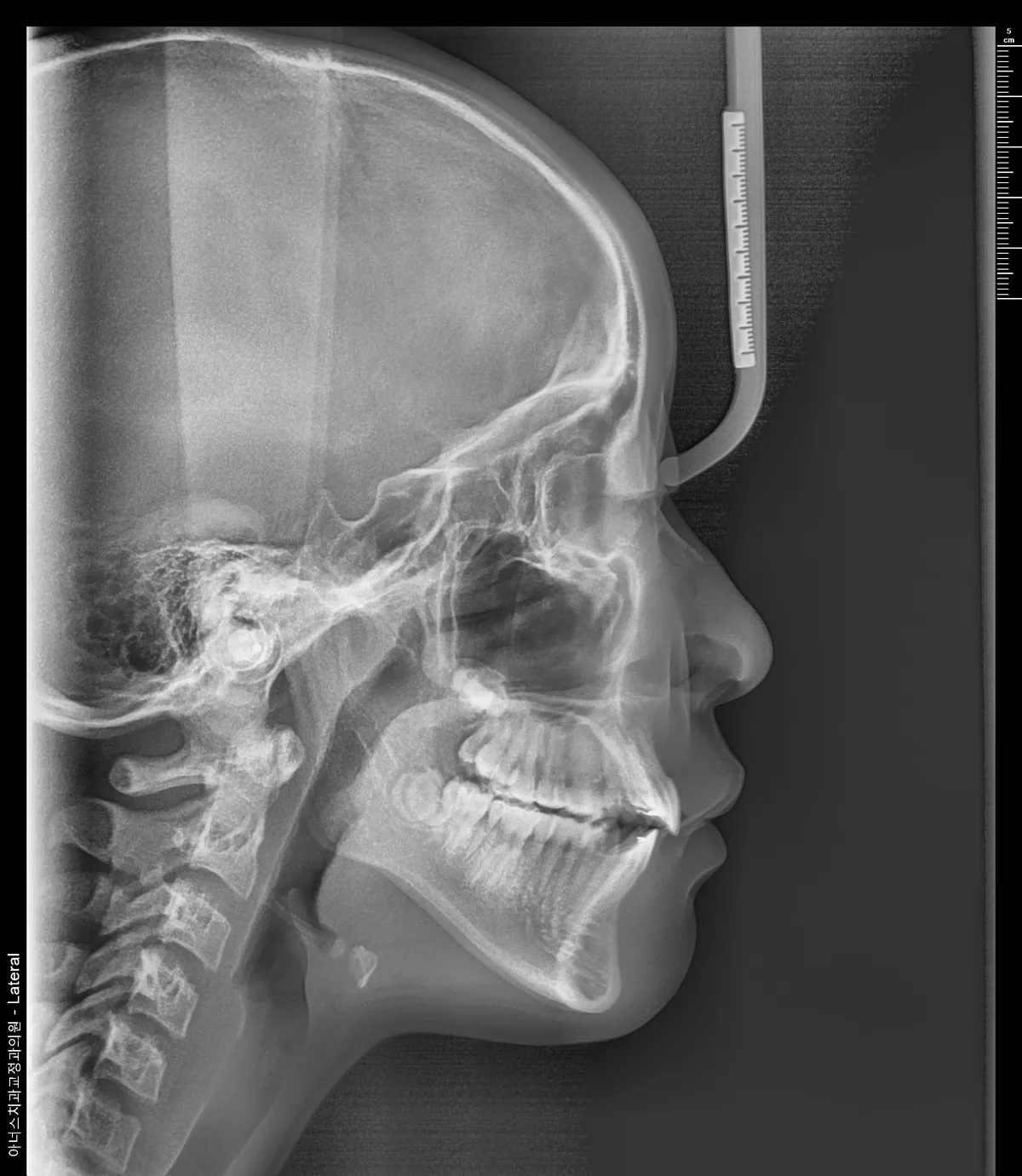 Lateral Ceph