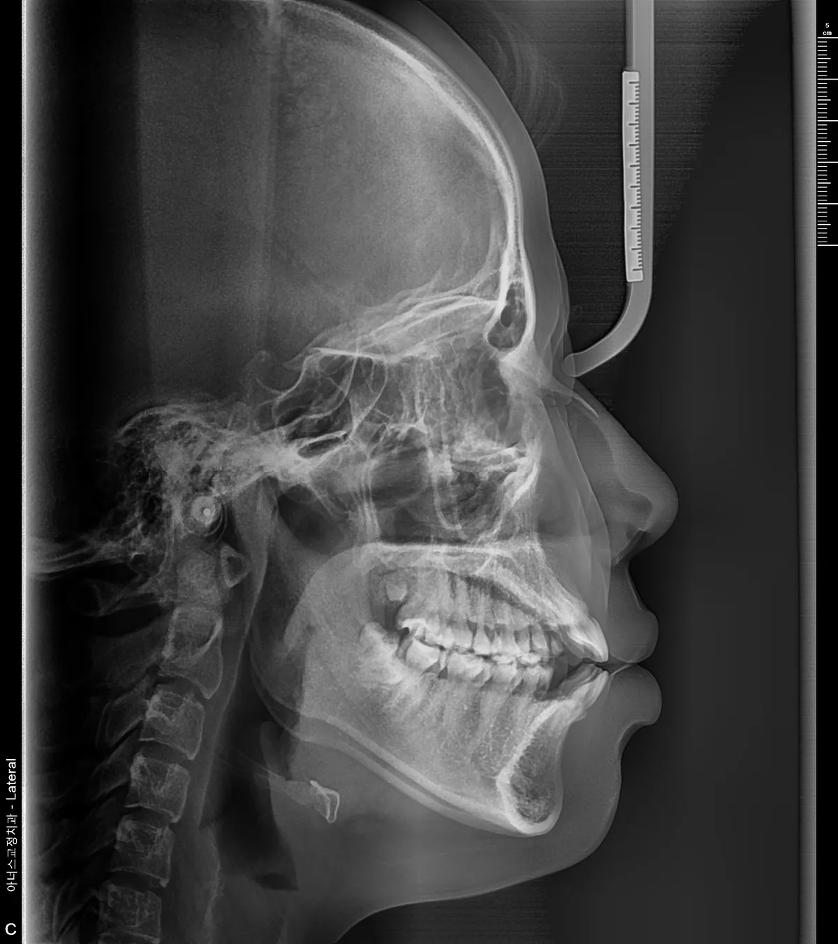Lateral Ceph