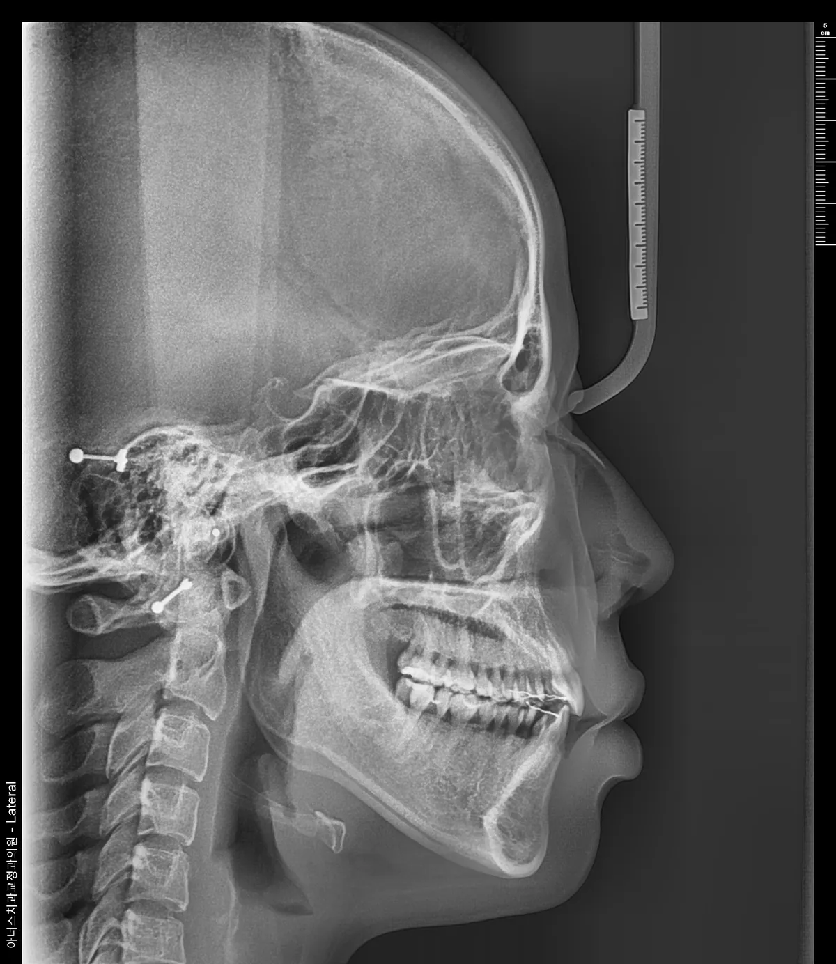 Lateral Ceph