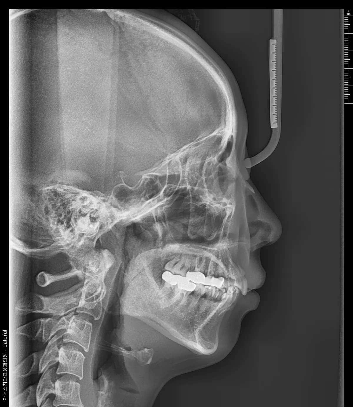 Lateral Ceph