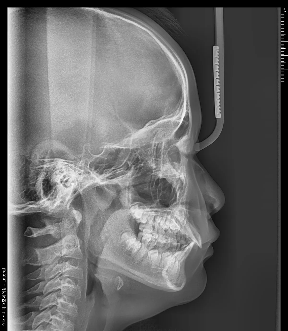 Lateral Ceph
