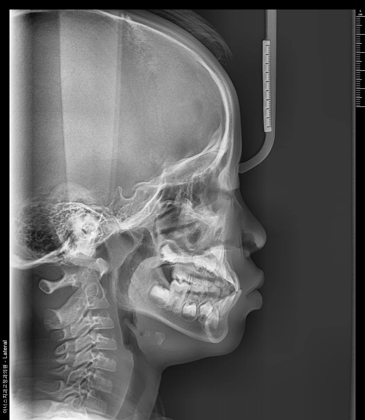 Lateral Ceph