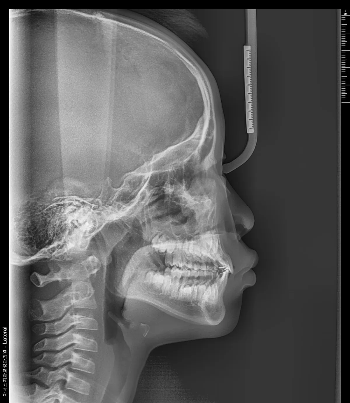 Lateral Ceph