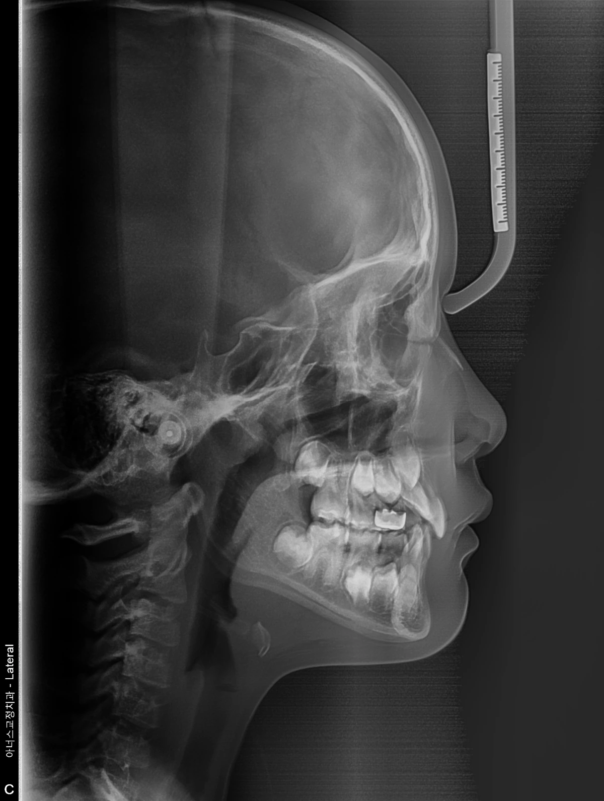 Lateral Ceph