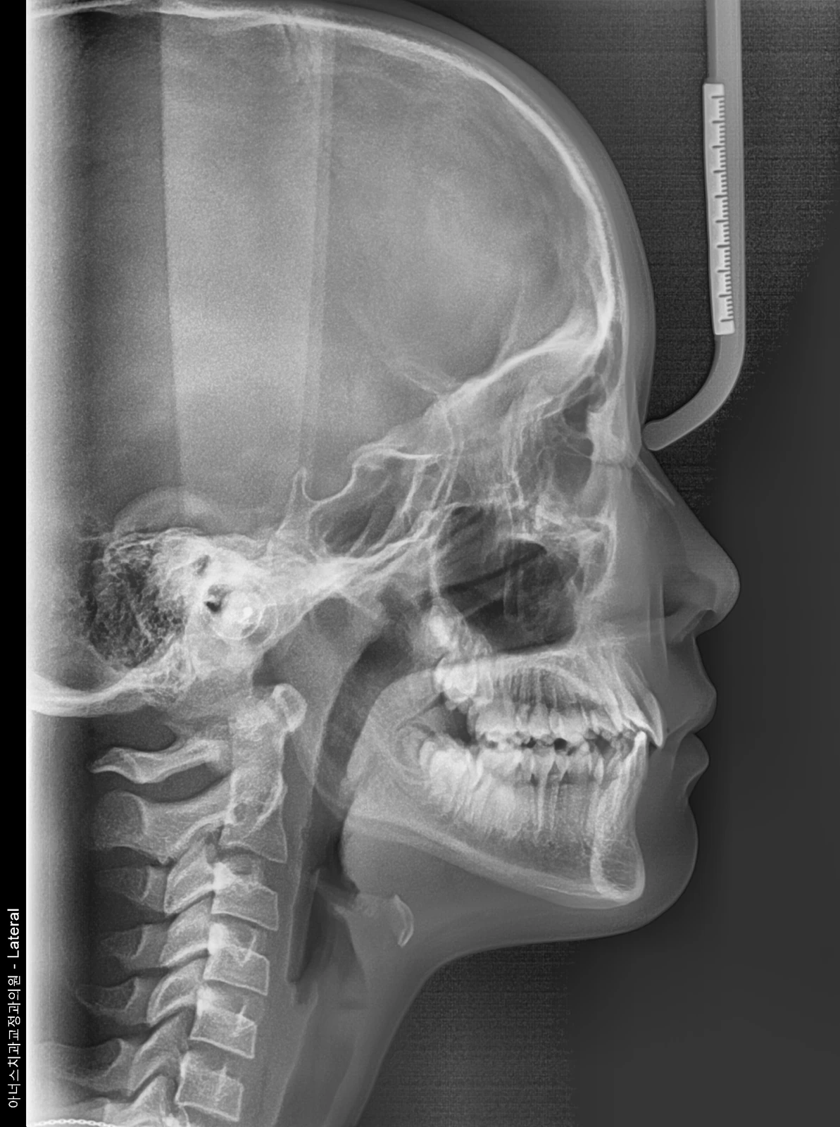 Lateral Ceph