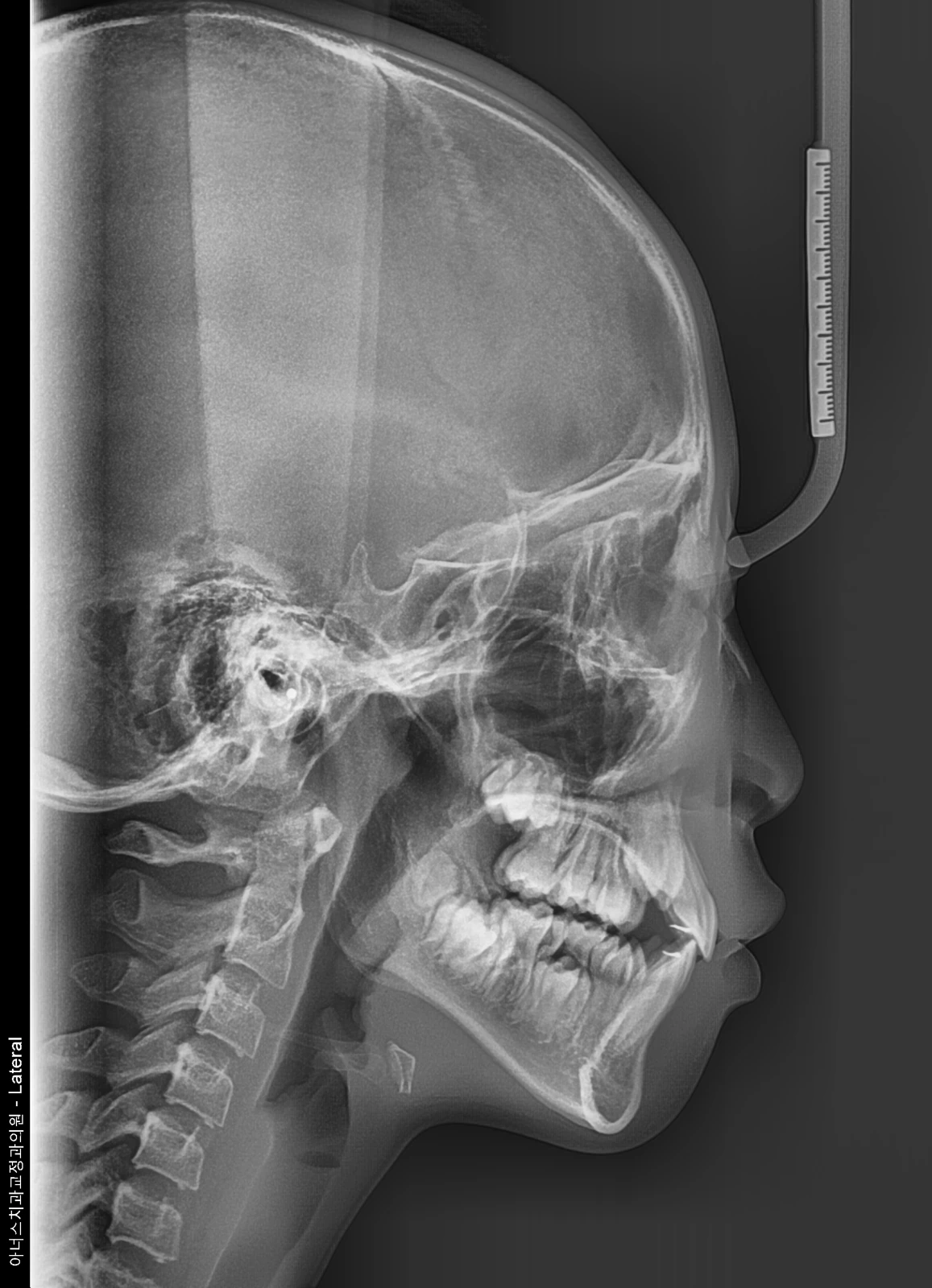 Lateral Ceph